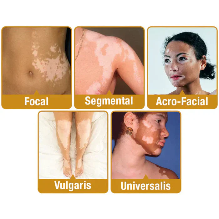 Bee Venom Vitigo Correcting Cream š§”(BUY1 GET1 FREE )š„³