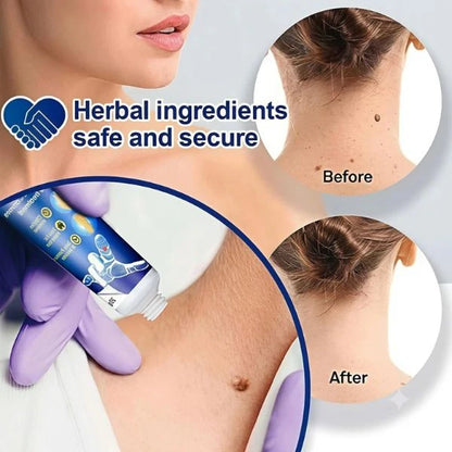 Wart Remover Gel for Man / Woman (Buy 1 Get 1 Free)