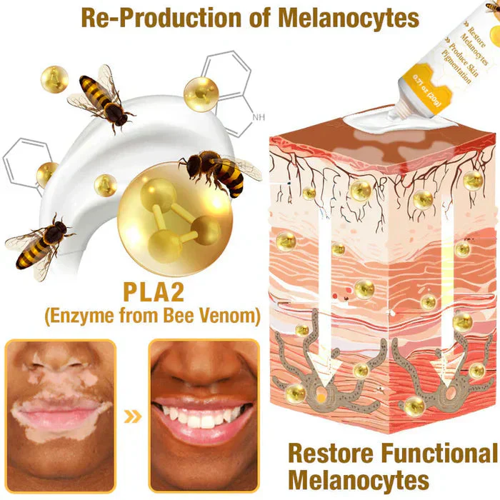 Bee Venom Vitigo Correcting Cream 🧡(BUY1 GET1 FREE )🥳