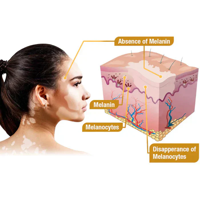 Bee Venom Vitigo Correcting Cream 🧡(BUY1 GET1 FREE )🥳